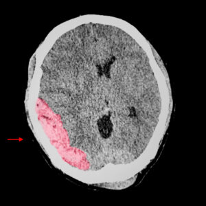 What is the average traumatic brain injury in a car accident settlement in Georgia?