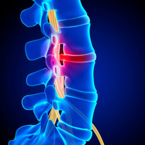 What is the average herniated disc settlement value in Georgia? Recent examples of herniated disc settlement amounts near you in Georgia that Kalka law group won for our clients.